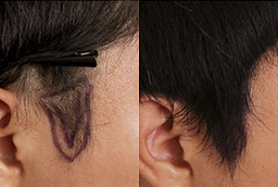 Sideburn Hair Transplant After and Before