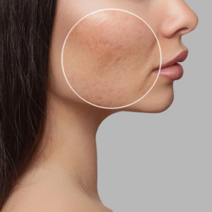 Blog 17 Subcision Treatment For Acne Scars Cost in Abu Dhabi