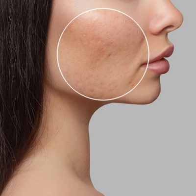 Subcision Treatment For Acne Scars Cost in Abu Dhabi
