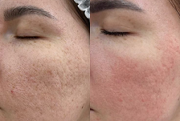 Subcision Treatment for Acne Scar After and Before