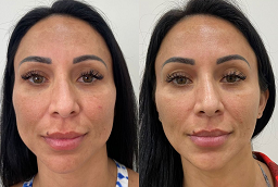 Ultherapy After and Before
