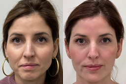 Ultherapy Before and After