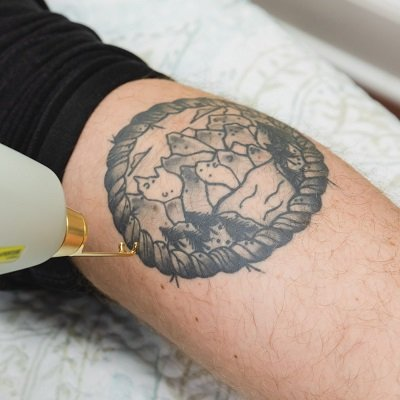 What Laser Tattoo Removal Options Are Available