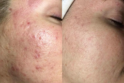 Acne Scar treatment After and Before