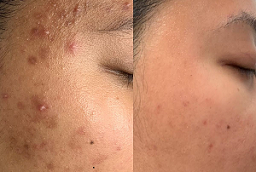 Acne Scar treatment Before and After