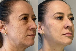 Before And After Morpheus 8 Treatment