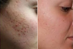 Before and After Acne Scar treatment