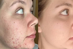 Before and After Pimples Treatment