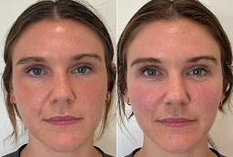 Salmon DNA Treatment 8 Before and After Salmon DNA Treatment