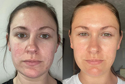Before and After Spectra Laser Carbon Peel