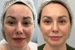 Endolift After and before