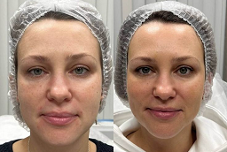 Endolift Before and After