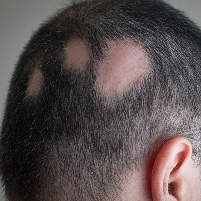 How to Prevent Hair Loss and Balding 3 How to Prevent Hair Loss and Balding