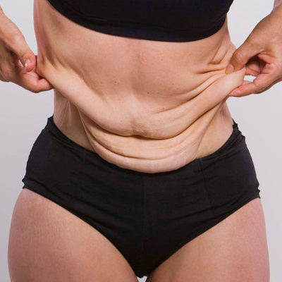 How to Tighten Skin After Weight Loss 2 How to Tighten Skin After Weight Loss