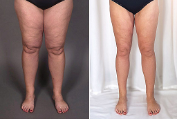 Lower Body Lift 8 Lower Body Lift Before and After
