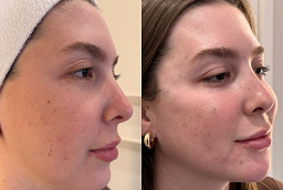 Morpheus 8 Treatment After And before