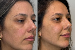 Morpheus 8 Treatment Before And After