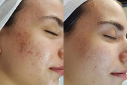 Pimples Treatment 8 Pimples Treatment After and Before