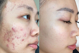 Pimples Treatment Before and After