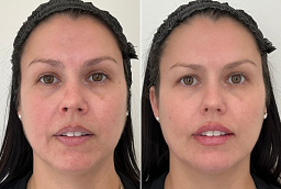 Salmon DNA Treatment After and Before