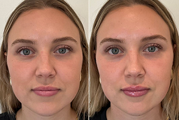 Salmon DNA Treatment Before and After