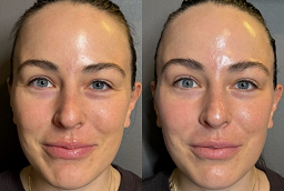 Spectra Laser Carbon Peel After and Before