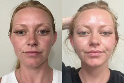 Spectra Laser Carbon Peel Before and After