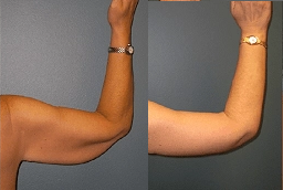 Arm Lift in Abu Dhabi | Brachioplasty 7 Arm Lift Before and After