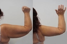 Arm Lift in Abu Dhabi | Brachioplasty 8 Before and After Arm Lift
