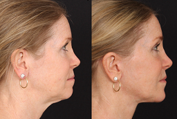 Before and After Chin Augmentation