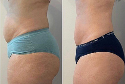 Fat Transfer Surgery Before and After