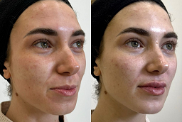 Before and After Fractional RF Micro Needling
