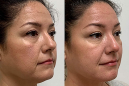 Before and After J Plasma Skin Resurfacing