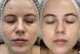 Before and After Laser Carbon Peel