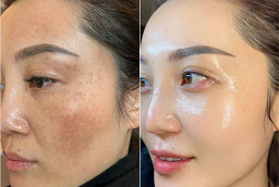 Before and After Melasma Treatment