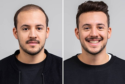 Before and After Natural Hairline Treatment