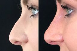 Before and After Non Surgical Nose Job