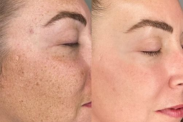 Before and After Pigmentation Treatment