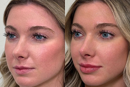 Before and After Radiofrequency Treatments