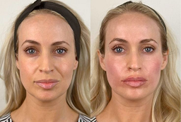 Before and After Skin Toning Treatment