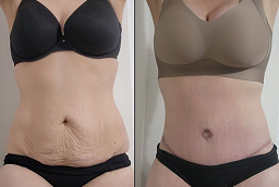 Before and After Slimming Treatments