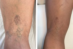 Before and After Spider Veins Treatment