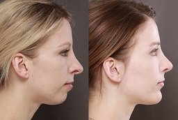 Chin Augmentation After and Before