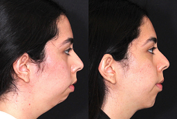 Chin Augmentation Before and After