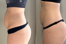 Fat Transfer Surgery Before and After