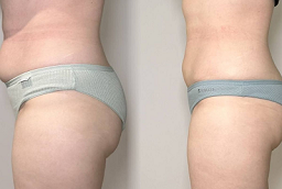 Fat Transfer Surgery Before and After