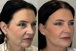 Fractional RF Micro Needling Before and After