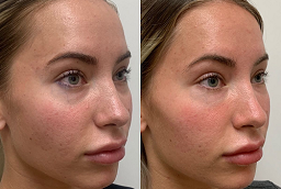 J Plasma Skin Resurfacing After and Before