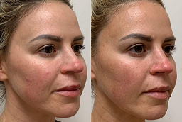 J Plasma Skin Resurfacing 8 J Plasma Skin Resurfacing Before And After