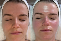 Laser Carbon Peel After and Before
